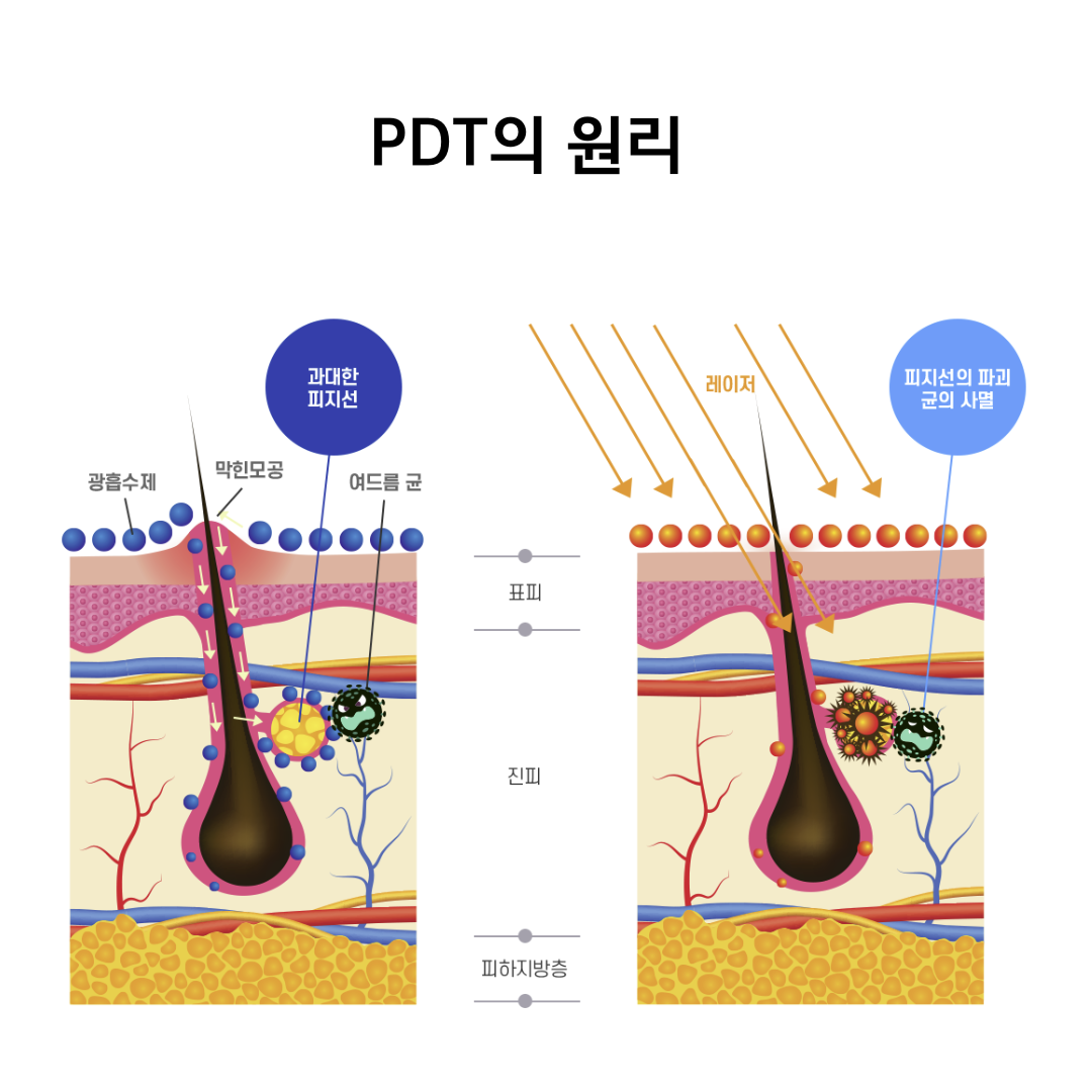 수원여드름