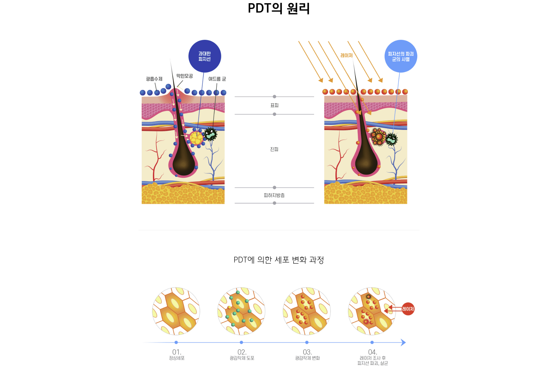 수원여드름